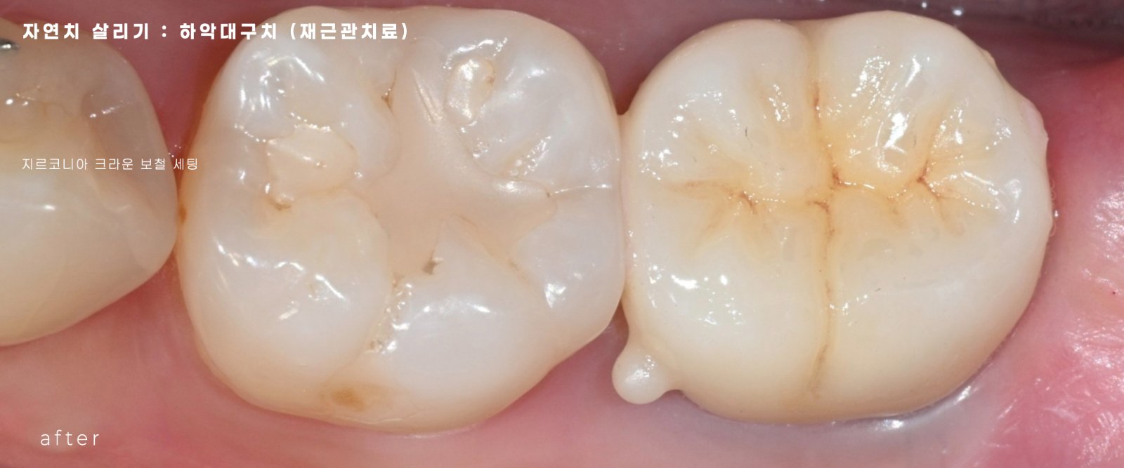 치아 빼지 않고 살리기, 현미경치과, 청주치과